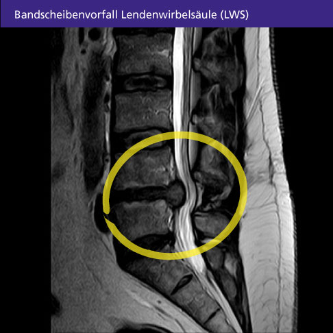 Röntgenbild eines Bandscheibenvorfalls der Lendenwirbelsäule