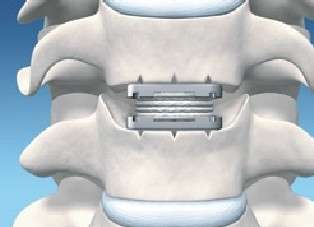 Zervikale Bandscheibenprothese kann die biologische Bandscheibe ersetzen 
