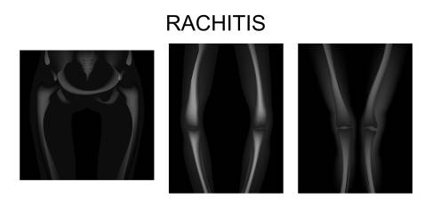 Fehlstellungen der unteren Extremitäten aufgrund von Rachitis