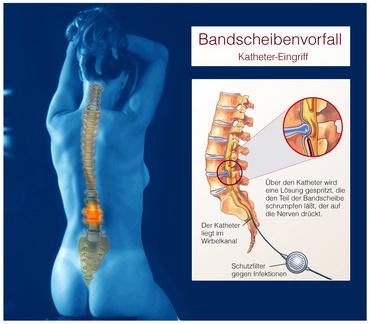 Behandlung von Rückenschmerzen mittels Racz-Katheter