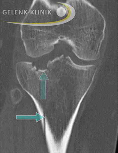 Tibiakopffraktur im Röntgen