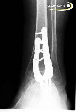 Versteifung des Sprunggelenks nach Revision einer Sprunggelenksprothese. Bei diesem Patienten erfolgte die Versteifung des oberen Sprunggelenks mit Hilfe einer Plattenosteosynthese. Die Platten werden von außen gegen das zu versteifende Gelenk geschraubt, um die Gelenkpartner in Position zu halten. © Gelenk-Klinik Versteifung des Sprunggelenks nach Ausbau einer Sprunggelenksprothese