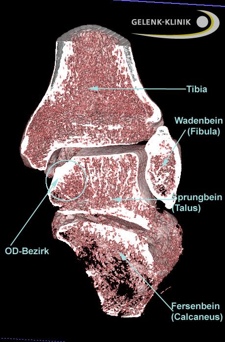 Ansicht des Sprunggelenks von hinten in der digitalen Volumentomografie (DVT): Schienbein (Tibia) und Wadenbein (Fibula) bilden gemeinsam die Sprunggelenksgabel. Der fußseitige Gelenkpartner, der das gesamte Körpergewicht aufnimmt, ist das Sprungbein (Talus). Eine Osteochondrosis dissecans des Sprunggelenks bildet sich immer am Talus aus. Meist sind die konvexen Ränder des Talus von der OD betroffen. © Gelenk-Klinik Osteochondrosis dissecans im Sprunggelenk