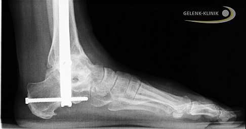 Die Arthrodese des Sprunggelenks kann auch mit Hilfe eines Marknagels durchgeführt werden, der Schienbein, Sprungbein und Fersenbein stabil verbindet. Vor allem Arthrose des unteren Sprunggelenks und schwere Fehlstellungen des Fersenbeines können diese Methode der Sprunggelenksarthrodese erforderlich machen. Bei dieser Anwendung des Marknagels zur Versteifung des Sprunggelenks wird zusätzlich das Gelenk zwischen Fersenbein und Sprungbein versteift. © Gelenk-Klinik Arthrodese Sprunggelenk mit Marknagel