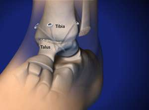 Arthrodese Sprunggelenk