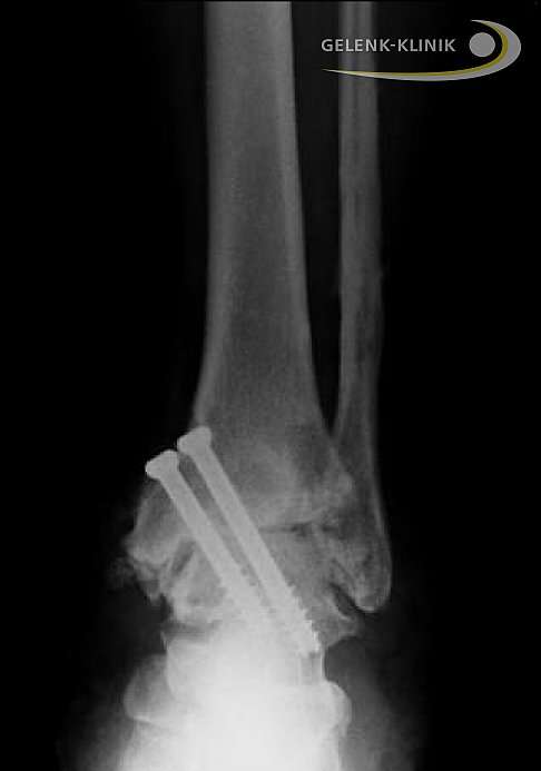 Mit Hilfe der Gelenkkapsel und der Sehnen und Bänder des Sprunggelenks wird zusätzlich zu den Knochenschrauben eine Stabilisierung des versteiften Sprunggelenks bis zur vollständigen Fusion ermöglicht. © Gelenk-Klinik.de Arthrodese Sprunggelenk Röntgenbild von vorne