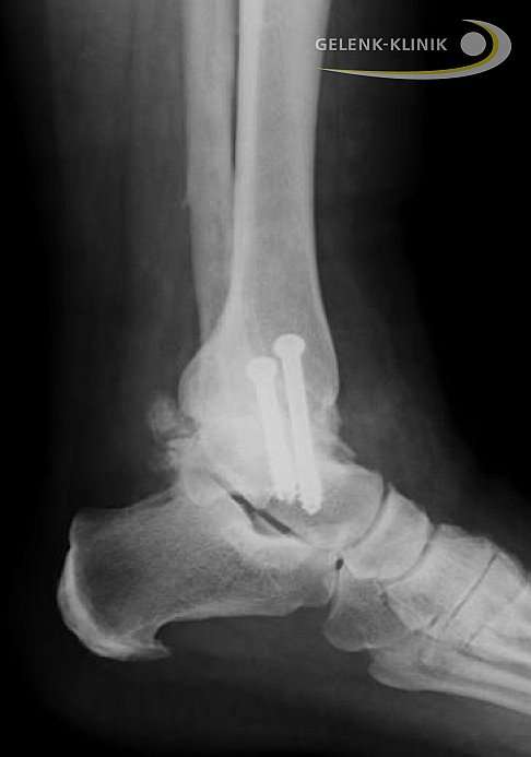 Die Arthrodese des Sprunggelenks kann für viele Patienten wieder schmerzfreie Belastbarkeit herstellen. Die Arthrodese des Sprunggelenks wird mit Schrauben oder Marknägeln durchgeführt, die das Gelenk in fester Position fixieren, bis die Verknöcherung vollständig ist. © Gelenk-Klinik Arthrodese Sprunggelenk
