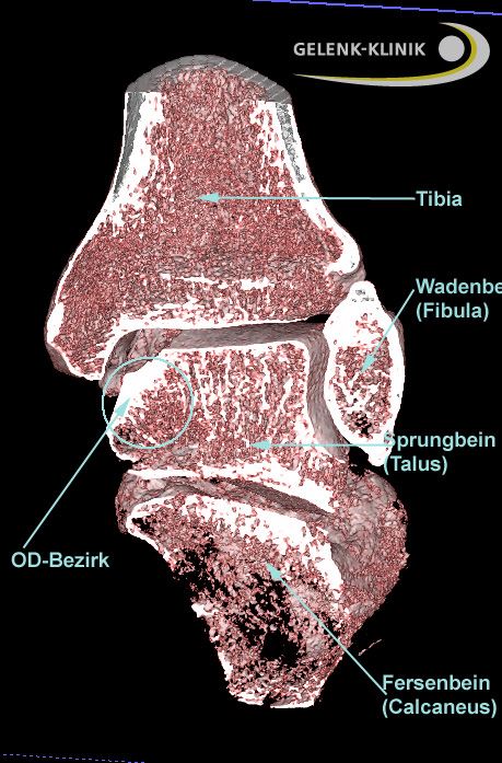 Ansicht des Sprunggelenks von hinten in der 3-D digitalen Volumentomographie (DVT): Von oben kommen Schienbein (Tibia, links) und Wadenbein (Fibula, rechts) und bilden gemeinsam die Sprunggelenksgabel. Fußseitiger Gelenkpartner, der das gesamte Körpergewicht aufnimmt, ist das Sprungbein (Talus). Die DVT (digitale Volumentomographie) bildet vor allem die knöchernen Strukturen sehr gut ab. Weichteilstrukturen sind mit der MRT wesentlich detaillierter zu sehen. © Gelenk-Klinik Digitale Volumentomographie: Osteochondrosis dissecans im Sprunggelenk