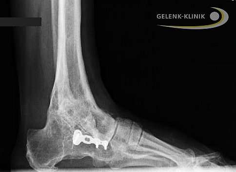 Die pantalare Arthrodese des Sprunggelenks verbindet Sprungbein (Talus), Schienbein (Tibia), das Kahnbein (Os naviculare und das Würfelbein (Cuboid) miteinander. Die pantalare Arthrodese ist also eine Versteifung des unteren Sprunggelenks. Damit wir die normale Rückfußfunktion stark verändert. Diese umfassende Versteifung aller wesentlichen Fußgelenke wird bei umfassenden Erkrankungen der Gelenke und Sehnen am Fuß als Mittel der letzten Wahl durchgeführt. © Gelenk-Klinik Pantalare Arthrodese des Sprunggelenk