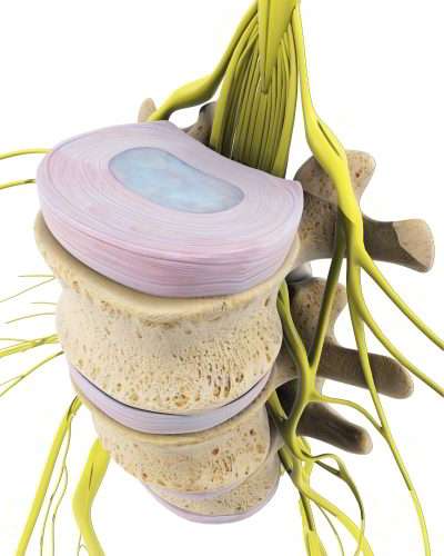 Die Bandscheibe besteht aus der zähen bindegewebigen Hülle (Anulus fibrosus) und dem flüssigen Kern (Nucleus pulposus). Die Bandscheibe federt Stöße ab. Sie ermöglicht als Gleitschicht zwischen den knöchernen Wirbelkörpern die Beweglichkeit der Wirbelsäule. Fällt eine Bandscheibe aus, bilden sich knöcherne Anbauten am Rand der Wirbelkörper, sogenannte Spondylophyten. Dies engt den verfügbaren Raum für das Rückenmark und die Spinalnerven ein und stört langfristig die normale Funktion des Nervensystems. © Viewmedica Anatomische Darstellung einer einzelnen Bandscheibe