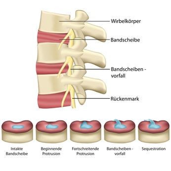 Stadien der Bandscheibendegeneration mit Bildung eines Sequesters