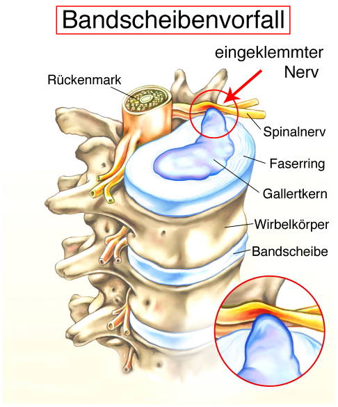 Aufgrund von Verschleiß oder Traumata kann der Kern einer Bandscheibe aus seinem festen Faserring heraustreten und auf den Spinalnerven oder seine Nervenwurzel drücken. Der Patient verspürt bei einem Bandscheibenvorfall starke Rückenschmerzen, Sensibilitätsstörungen in Armen oder Beinen sowie z. T. Harn- und Stuhlinkontinenz. © Henrie, Adobe Stock Schematische Darstellung eines Bandscheibenvorfalls
