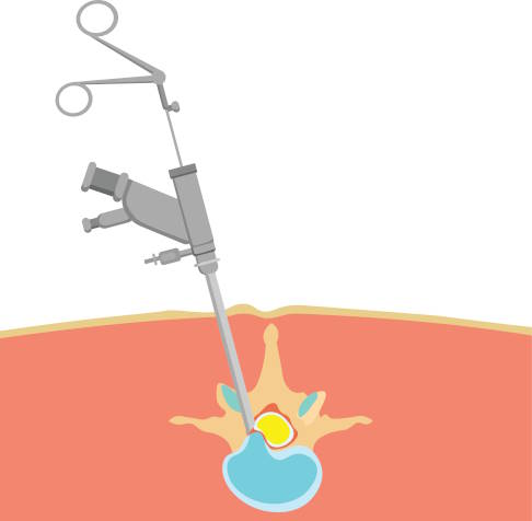Der endoskopische Zugang ermöglicht es, einen Bandscheibenvorfall durch kleinste Zugänge zu operieren. © RenytaAP, Adobe Endoskopie bei einem Bandscheibenvorfall