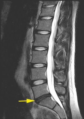 Degenerierte Bandscheibe mit vermindertem Wassergehalt (Pfeil). © Gelenk-Klinik Degenerierte Bandscheibe