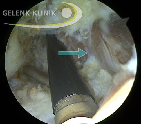 Der Operateur hat mit einem speziellen Instrument Vernarbungen und Verwachsungen innerhalb des Gelenkes gelöst (Pfeile). © Gelenk-Klinik Kamerabild nach Arthrolyse im Ellenbogengelenk