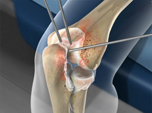 Die Arthroskopie ist eine minimalinvasive Operation des erkrankten Ellenbogengelenks. © Viewmedica Arthroskopie des Ellenbogengelenks