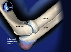 Die Schleimbeutelentzündung (Bursitis) am Ellenbogen ist häufig sehr schmerzhaft. © Viewmedica Schleimbeutelentzündung am Ellenbogen