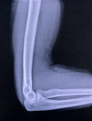 Der Ellenbogen ist ein sogenanntes Drehscharniergelenk. Lediglich Beugung und Streckung sowie Einwärts- und Auswärtsdrehung sind möglich. Drei Knochen bilden das Ellenbogengelenk: Oberarmknochen (Humerus), Elle (Ulna) und Speiche (Radius). Zusätzlich fixieren Bänder und Muskeln die Knochen. © Milton Oswald, Fotolia Ellenbogenschmerzen