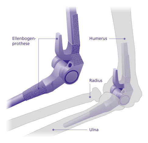 Die Ellenbogenprothese besteht aus zwei Schenkeln aus hochwertigem Metall. Diese beiden Schenkel werden in den Schaftanteilen von Ober- und Unterarm fest verankert und ersetzen die Knochenanteile, die das natürliche Ellenbogengelenk formen. Sie sind durch ein Scharnier aus Metall und Kunststoff miteinander verbunden, das die Beugung des künstlichen Ellenbogengelenks ermöglicht. © Gelenk-Klinik Aufbau einer Ellenbogenprothese