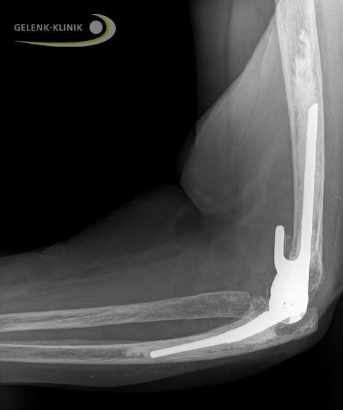 Seitliche Röntgenaufnahme des Ellenbogengelenks nach Implantation einer Ellenbogenprothese in den Knochenschaft des Oberarms (Humerus) und der Elle (Ulna). Alle Komponenten des Ersatzgelenks sind miteinander verbunden (gekoppelte Ellenbogenprothese) und arbeiten wie ein Scharnier. Der Kopplungsmechanismus übernimmt die stabilisierende Funktion des Bandapparats und gewährleistet eine gute Gelenkstabilität. © Gelenk-Klinik Ellenbogenprothese