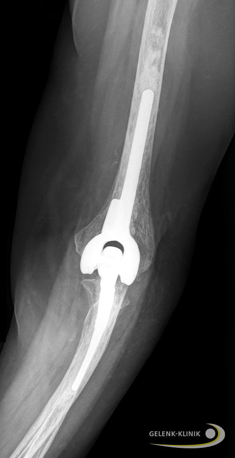 Die intakten Sehnen und Muskeln übernehmen die Beuge- und Streckfunktion des Ellenbogengelenks. Es ist durch die Prothese wieder aktiv schmerzfrei beweglich.© Gelenk-Klinik Gekoppelte Ellenbogenprothese von hinten