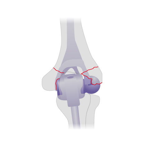 Die Abbildung zeigt eine implantierte Ellenbogenprothese nach einem komplizierten Bruch des Ellenbogengelenks von hinten. Die roten Linien markieren die Frakturlinien. © Gelenk-Klinik Schema Ellenbogenprothese von hinten