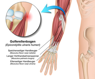 Die Sehnenansätze der Unterarmmuskeln auf der Ellenseite sind beim Golferellenbogen gereizt. © bilderzwerg, Fotolia Anatomie der Ellenbogenmuskeln, deren Ansätze beim Golferellenbogen gereizt sind