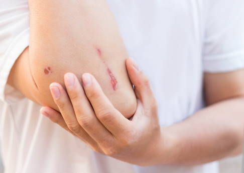 Durch einen Sturz kann es zu einer Hautabschürfung kommen. Man spricht auch von einer Läsion. © nespix, Adobe Stock Läsion am Ellenbogen