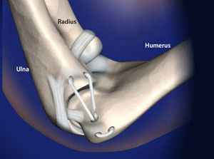 Stabilisierungs-Operation des Ellenbogengelenkes nach Bandverletzung