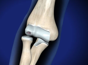 Löst sich ein Knochen-Knorpel-Stück im Ellenbogengelenk, spricht man von Osteochondrosis dissecans. © Viewmedica Ellenbogengelenk mit Osteochondrosis dissecans