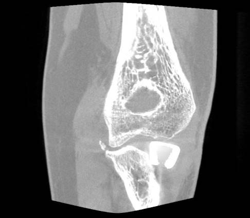 Overstuffing einer auswärts implantierten Radiuskopfprothese: Das bedeutet, dass die Gesamtlänge der Speiche mit der implantierten Prothese die ursprüngliche Länge des Speichenknochens übersteigt. © Gelenk-Klinik Overstuffing einer Radiuskopfprothese