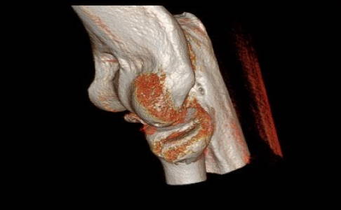 Seitliche Ansicht auf das Radiusköpfchen. © Gelenk-Klinik dislozierte (verschobene) Radiusköpfchenfraktur im DVT
