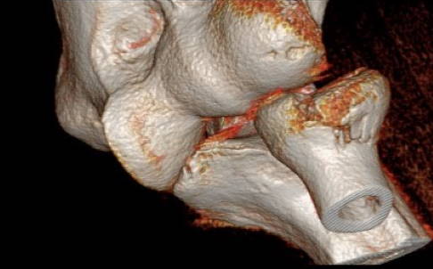 Die digitale Volumentomografie zeigt eine dislozierte (verschobene) Radiusköpfchenfraktur. © Gelenk-Klinik dislozierte (verschobene) Radiusköpfchenfraktur im DVT