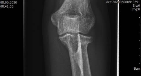 Röntgenbild von hinten auf den Ellenbogen, gleicher Patient. © Gelenk-Klinik Röntgenbild: Ansicht von hinten auf das Ellenbogengelenk