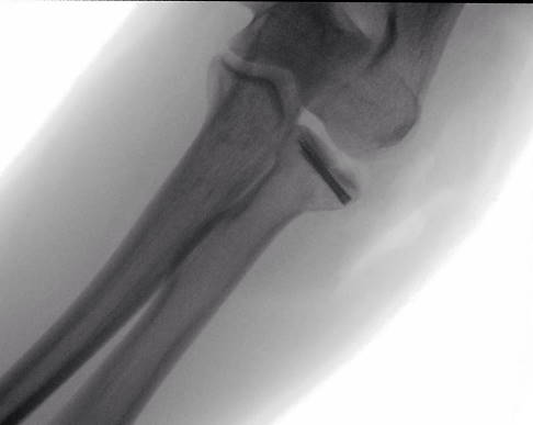 Die Radiusköpfchenfraktur wurde mittels Schrauben und Platten versorgt (Schraubenosteosynthese). © Gelenk-Klinik Röntgenbild einer Schraubenosteosynthese bei Radiusköpfchenfraktur
