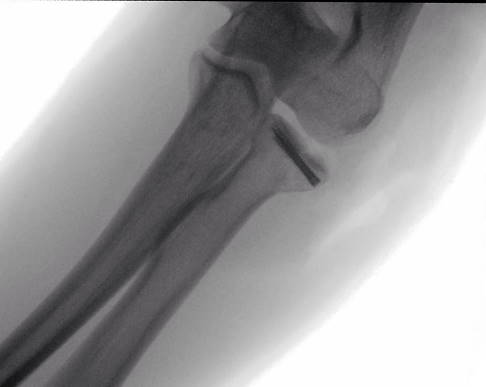 Röntgenbild einer Schraubenosteosynthese bei Radiusköpfchenfraktur