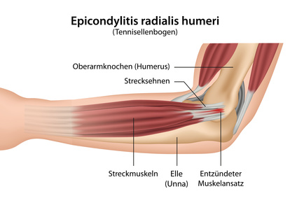 Der Tennisarm oder Tennisellenbogen (Epikondylitis humeri radialis) führt zu Schmerzen an der Außenseite des Ellenbogens. © bilderzwerg, Fotolia Tennisarm