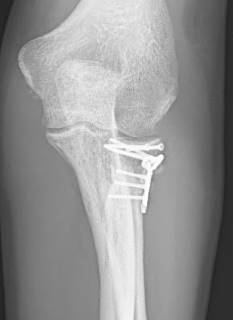 Röntgen: kombinierte Schraubenosteosynthese und Osteosynthese mit einer winkelstabilen Platte bei einem Patienten mit einem Trümmerbruch des Radiusköpfchens (Mason 3) nach einem Sturz vom Mountainbike. Das Röntgenbild zeigt bereits die Ausheilungssituation. Auffällig sind Verknöcherungen über der Platte wie sie typisch für schwere Verletzungen am Ellenbogen sind. © Gelenk-Klinik Röntgenbild einer Osteosynthese des Ellenbogens