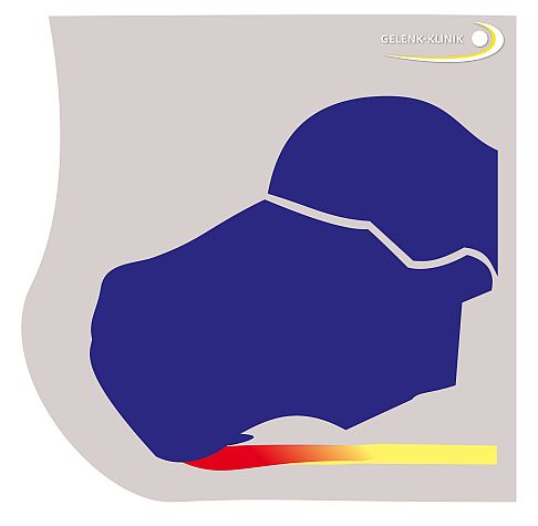 Der untere Fersensporn entsteht meist durch eine Entzündung des fersenseitigen Ansatzes der Plantarsehne, einer sogenannten Plantarfasziitis. © Dr. Thomas Schneider Plantarsehnenentzündung bzw. unterer Fersensporn