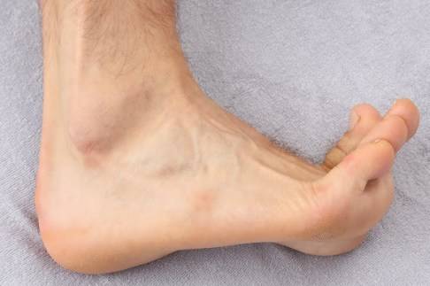 Das Anziehen der Zehen – die sogenannte Dorsalextension – dehnt die Plantarsehne. Diese Dehnung verstärkt den plantaren Fersenschmerz. © www.fuss-sprunggelenk-akademie.de Die Dorsalextension – Anziehen der Zehen – kann den plantaren (fußsohlenseitigen) Fersenschmerz auslösen.