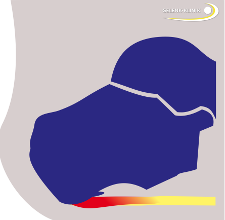 Darstellung eines unteren Fersensporns am Fersenbein (Calcaneus). Der knöcherne Anbau reizt den Ansatz der Plantarsehne (rot), der sich daraufhin schmerzhaft entzündet. © Gelenk-Klinik Unterer Fersensporn mit Plantarfasziitis