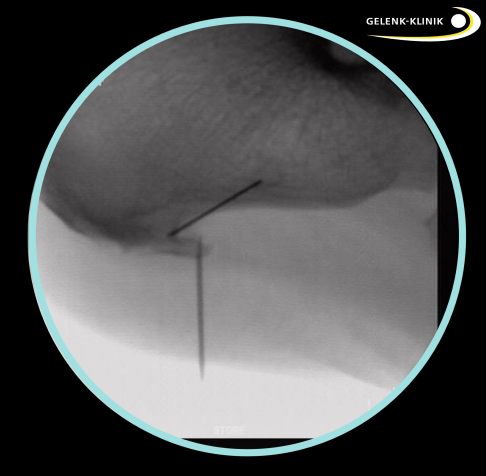 Markierung des Fersensporns: Zunächst lokalisiert der Operateur den Fersensporn mit einem beweglichen Röntgengerät und markiert ihn mit einer Nadel. © Gelenk-Klinik Markierung des Fersensporns unter Röntgenkontrolle