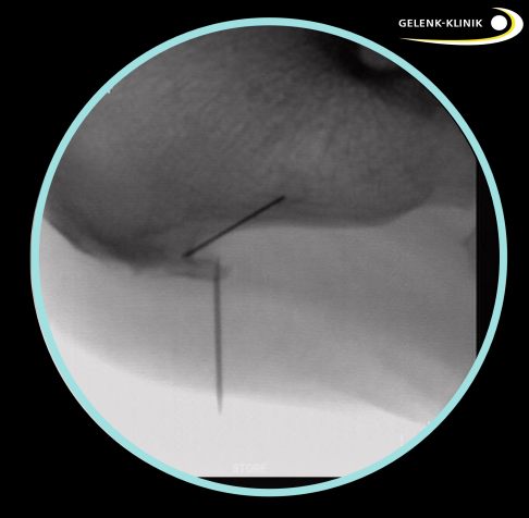 Markierung des Fersensporns unter Röntgenkontrolle