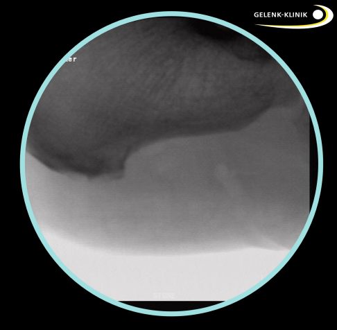Postoperative Röntgenkontrolle: Nach der Operation bestätigt eine Röntgenkontrolle das Ergebnis. © Gelenk-Klinik Röntgenkontrolle nach der Operation des Fersensporns