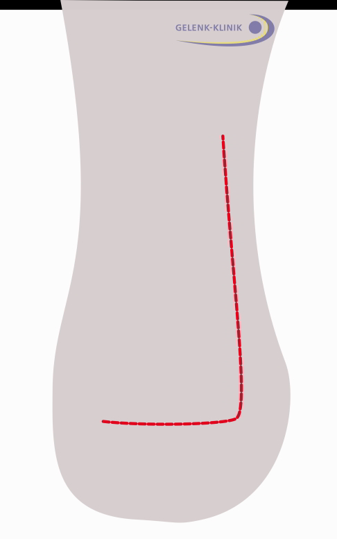 Operation der Haglundexostose 1. Schritt: Planung des Schnitts in der Fersenregion