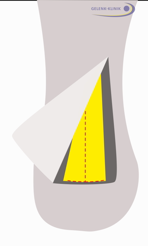 Operation der Haglundexostose 3. Schritt