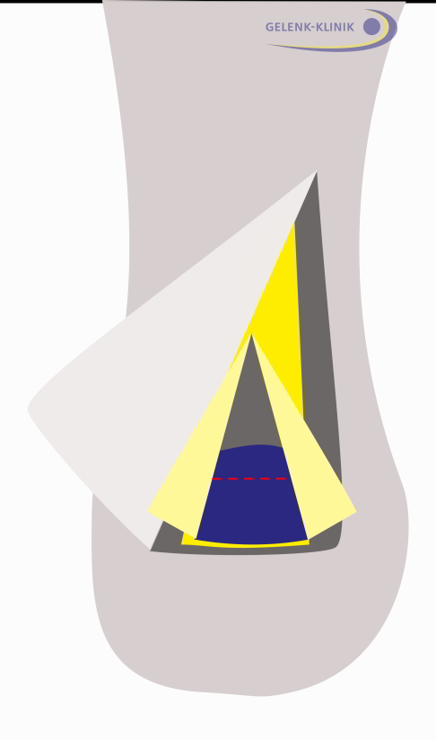 Operation der Haglundexostose 4. Schritt