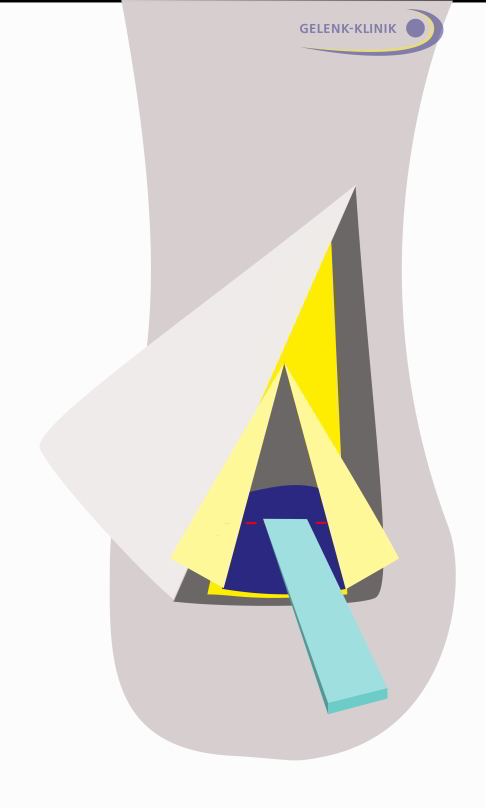 Operation der Haglundexostose 5. Schritt: Zugang durch Schnitt in der Fersenregion