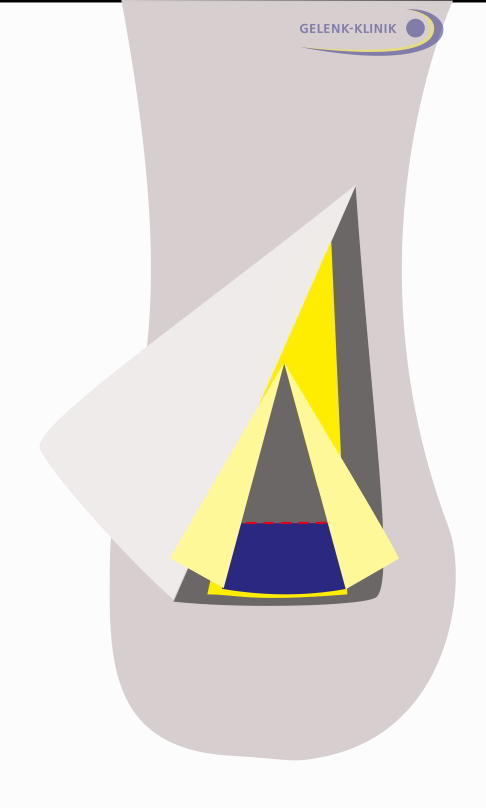 Operation der Haglundexostose