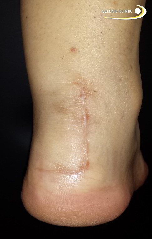 6. Schritt Operation der Haglundexostose Heilung